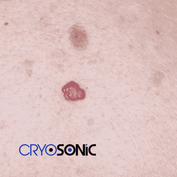 Looking for pain free cherry angioma removal treatment Camborne? Call our team today! Camborne