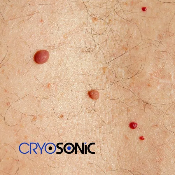 get cherry angioma removal treatment today! Camborne