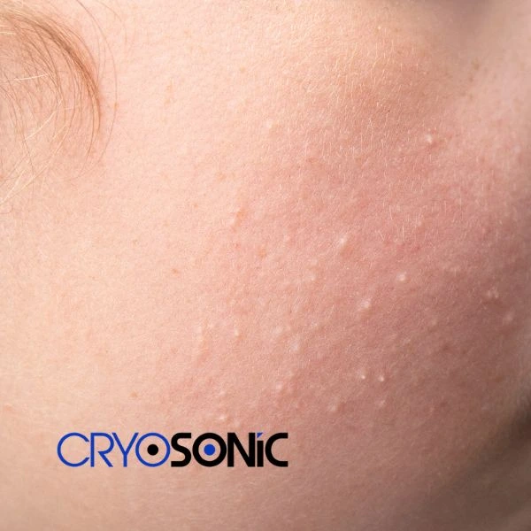 Are you looking for milia removal treatment? Contact our team today Camborne