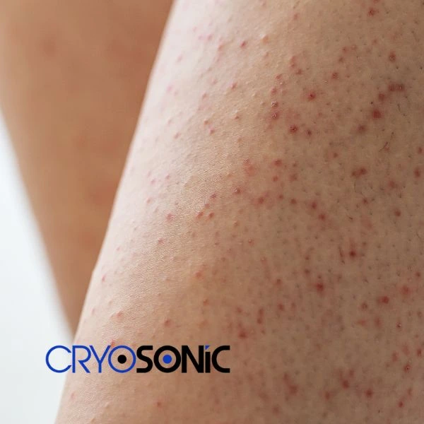Looking for Seborrhoeic Keratosis removal Camborne treatment? Call our consultants today in Camborne