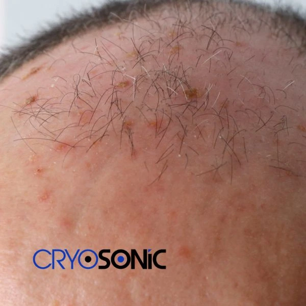 Access Seborrhoeic Keratosis removal from the comfort of your own home! Call us today in Camborne
