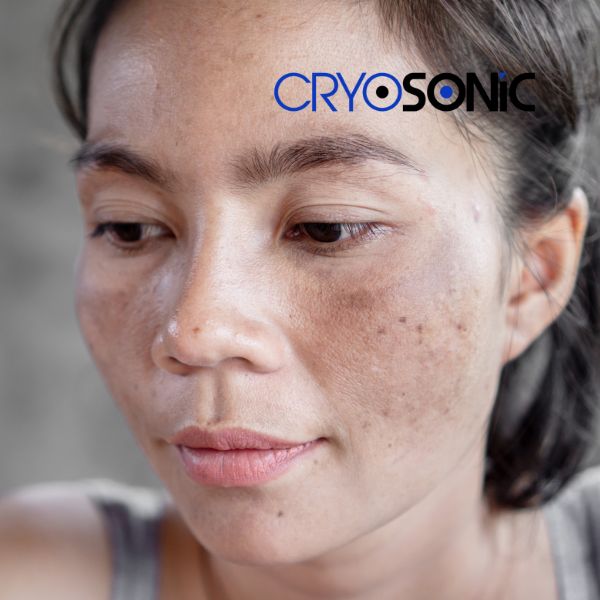 Ready to start age spots removal? Contact our team today in Camborne