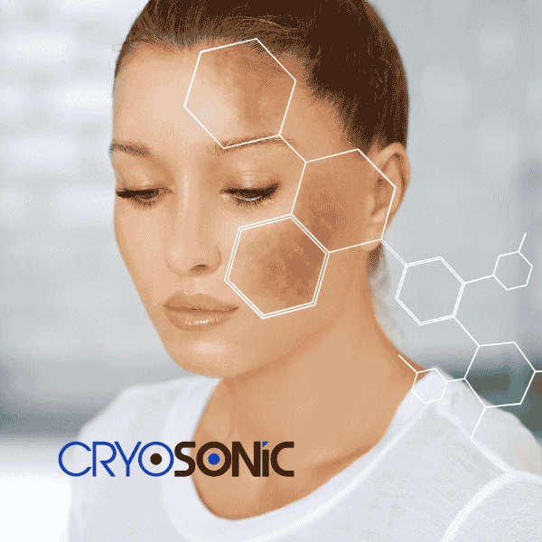 Are you looking for age spot removal treatment? Contact Cryosonic today in Camborne