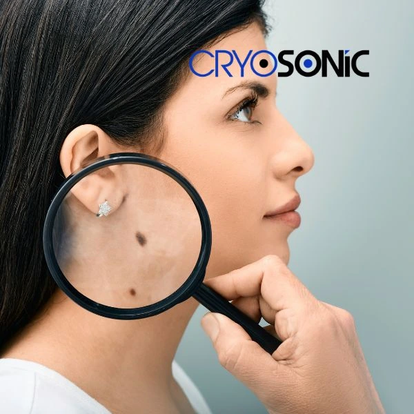 Do you want to learn more about benign moles removal treatment? Call our team today Camborne