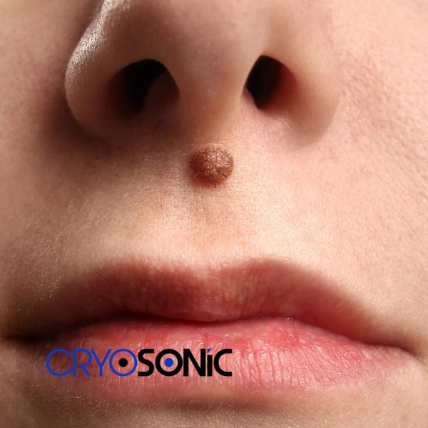 Start your benign moles removal treatment today Camborne