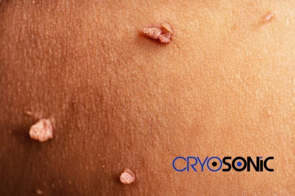 What Can You Expect During and After Your Cryosonic Treatment Camborne
