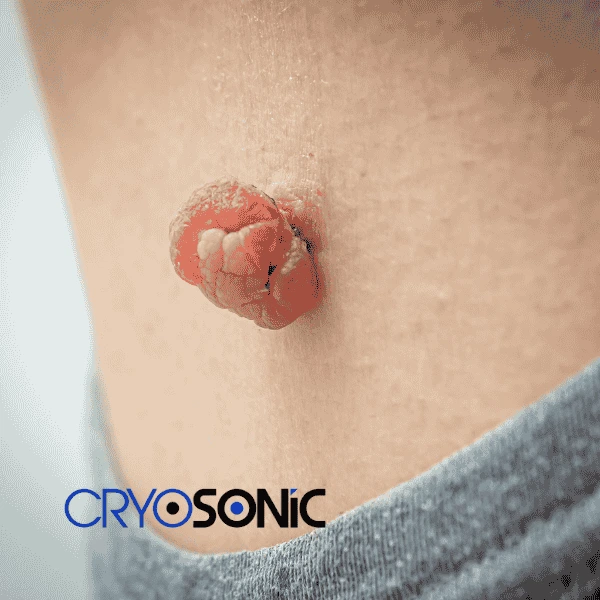Book your skin tags removal Camborne from comfort of your own home! Camborne
