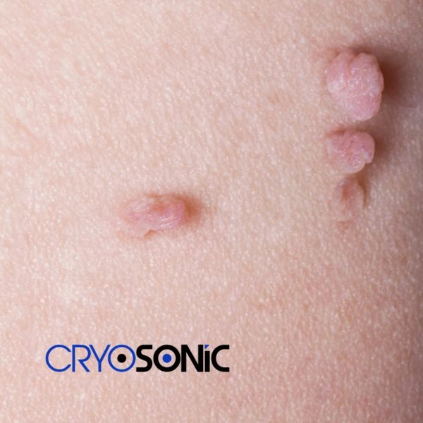 Are you looking for fast effect skin tag removal Camborne? Book in NOW! Camborne