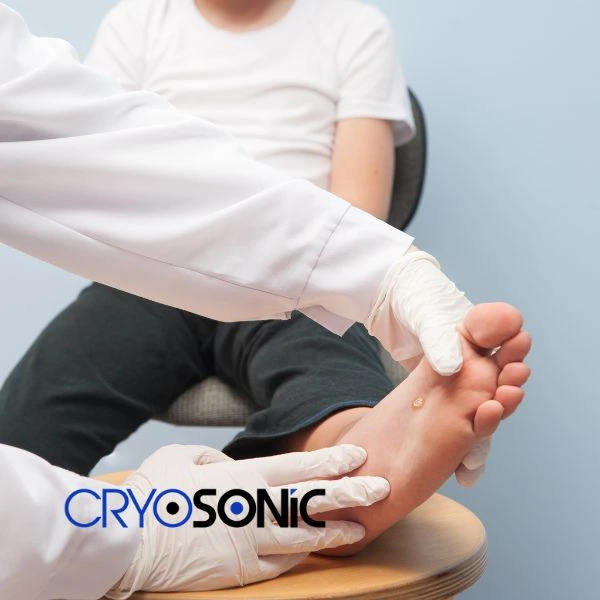 Are you looking for fast effective wart removal Contact us today Camborne