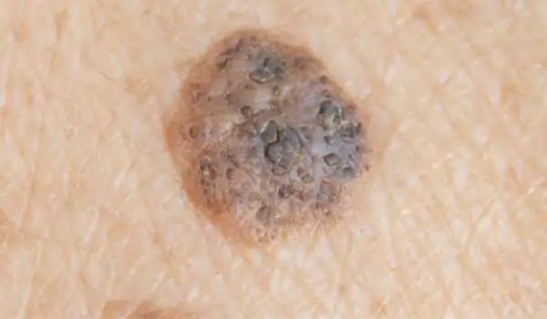 Seborrhoeic Keratosis: Benign vs Malignant Camborne