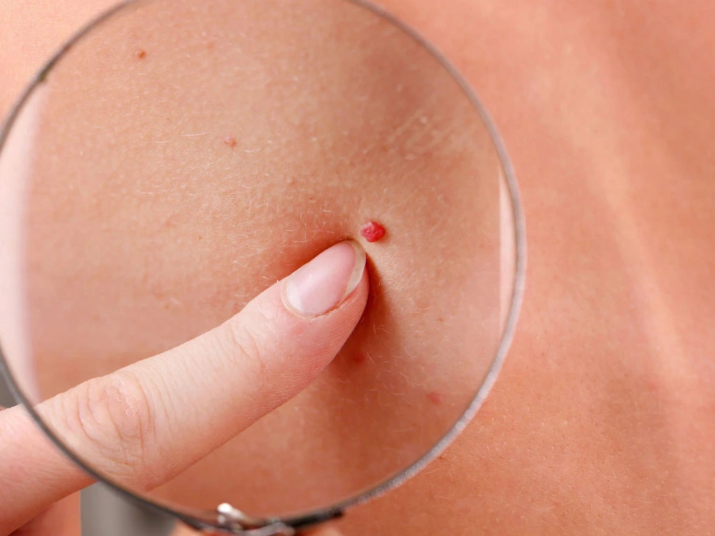 Cherry Angiomas on skin showing vascular structure and Cryosonic CryoPen treatment for effective lesion removal Camborne