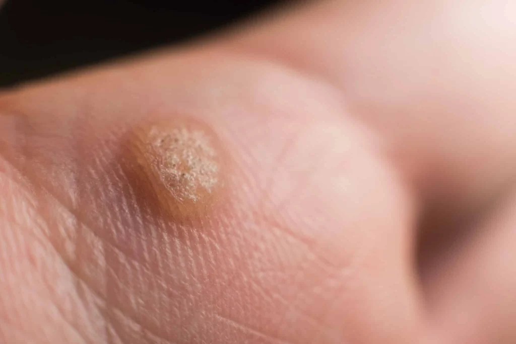 CryoPen treatment for Common Warts showing precise freezing of viral skin lesions for safe and effective removal Camborne