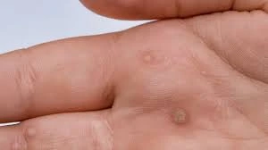 CryoPen treatment results showing smooth skin after Common Warts Camborne removal with reduced risk of recurrence Camborne