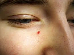 Benefits of Cryosonic CryoPen for Cherry Angiomas Camborne , showing precise, safe, and effective removal of vascular skin lesions Camborne