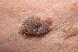 Role of CryoPen in managing Seborrhoeic Keratosis Camborne – safe and effective lesion removal Camborne