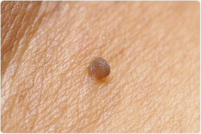 What happens in the skin to form Seborrhoeic Keratosis Camborne – causes and development of lesions Camborne