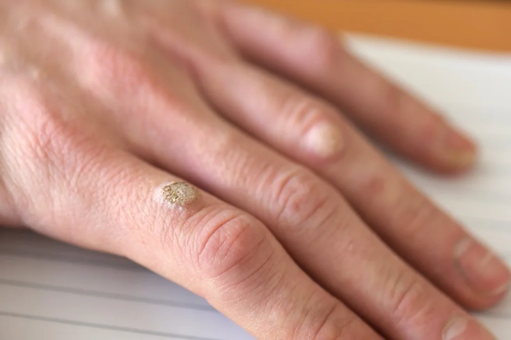 Patient considering removal of Common Warts Camborne for cosmetic improvement, comfort, and hygiene with CryoPen treatment Camborne