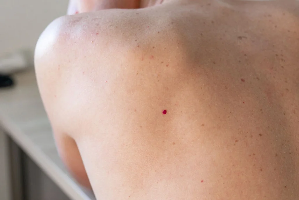 Close-up of Cherry Angiomas Camborne on skin, showing small red vascular lesions and their typical appearance Camborne
