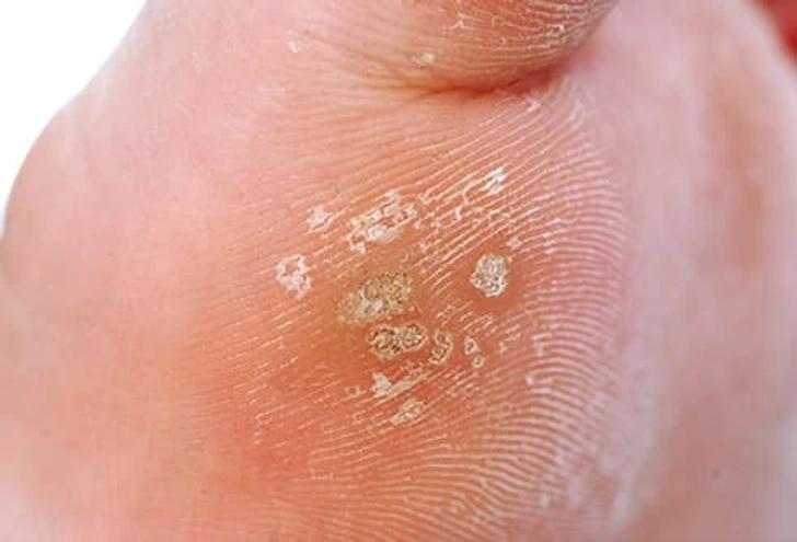 Close-up of Common Warts Camborne on skin, showing small rough viral lesions typically caused by HPV infection Camborne