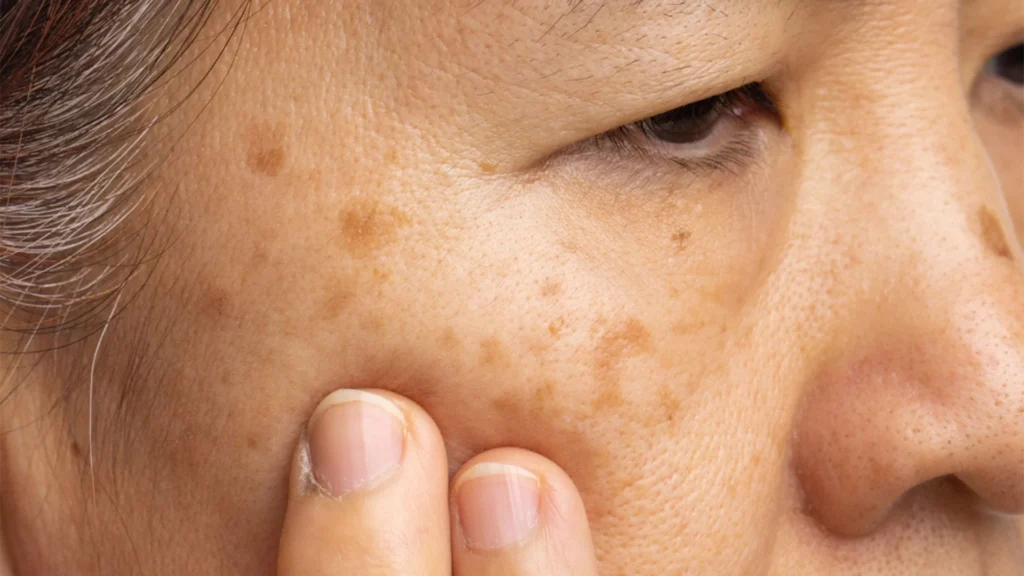 What exactly is Seborrhoeic Keratosis Camborne – causes, symptoms, and appearance Camborne