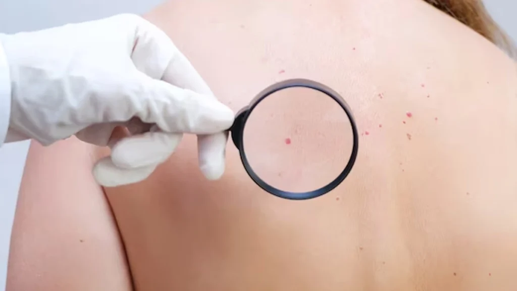 Person considering Cherry Angiomas Camborne removal, highlighting cosmetic and comfort reasons for treatment with CryoPen Camborne